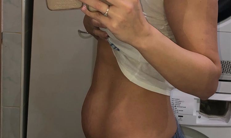 Liposukcia/abdominoplastika - 45989