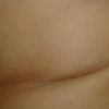 Jamky po abdominoplastike