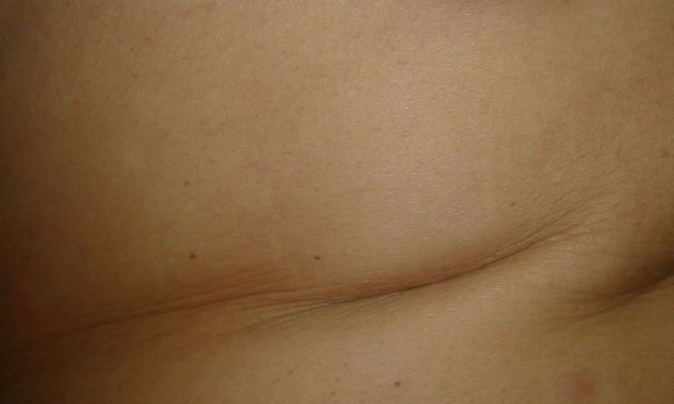 Jamky po abdominoplastike - 45993