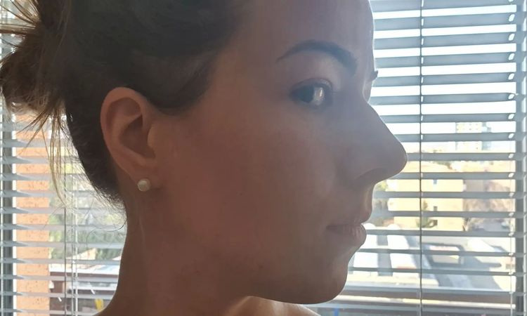 Rhinoplastika v lokálnej anestézii  - 46014