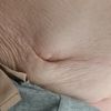 Abdiminoplastika -rozostup brusnych svalov