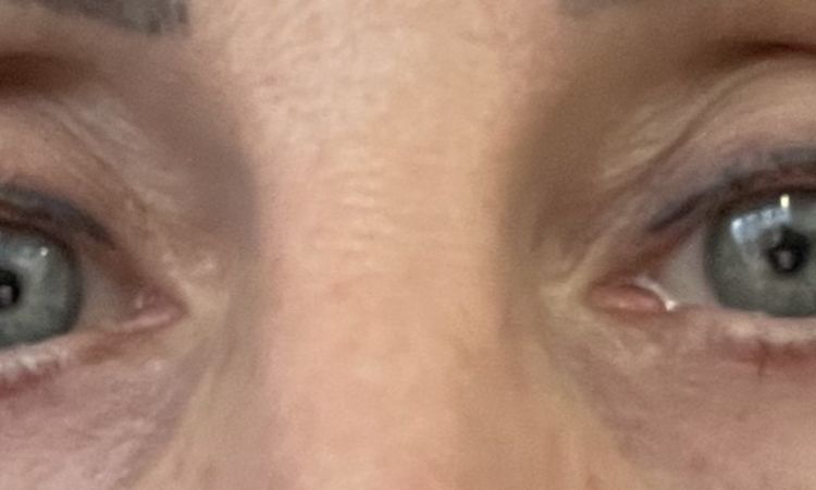 Blepharoplastika dolnych viecok - 48968