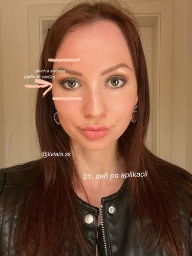 Botox a ovisnuté očné viečko