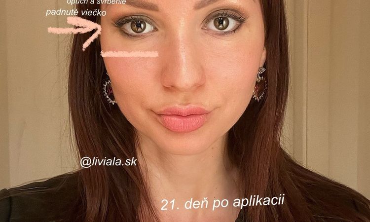 Botox a ovisnuté očné viečko - 52455