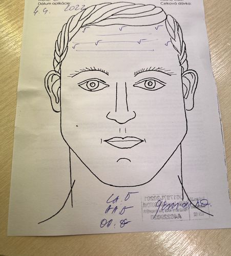 Botox a ovisnuté očné viečko