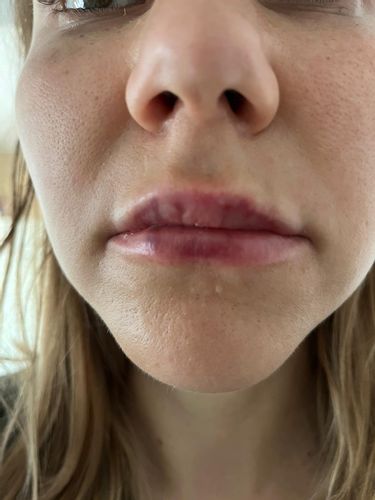 Asymetria a pluzgieriky po aplikacii kyseliny hylauronovej