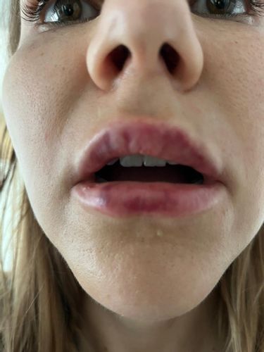 Asymetria a pluzgieriky po aplikacii kyseliny hylauronovej