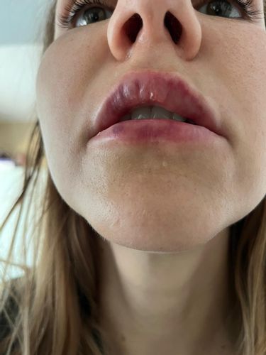 Asymetria a pluzgieriky po aplikacii kyseliny hylauronovej