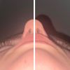 vyrovnanie tvrdej časti nosa