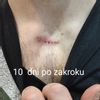Keloidna jazva na dekolte