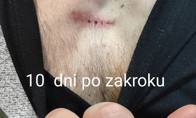 Keloidna jazva na dekolte - 60390