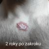 Keloidna jazva na dekolte