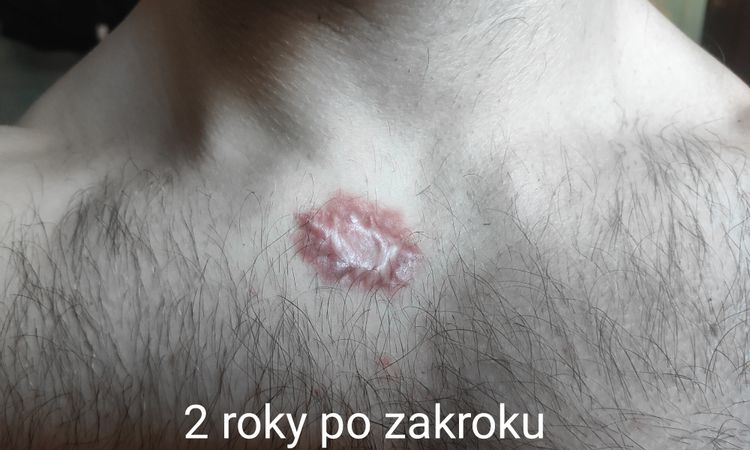 Keloidna jazva na dekolte - 60391
