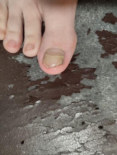 koľko by ma vyšiel zákrok keď potrebujem upraviť alebo skrátiť palec
