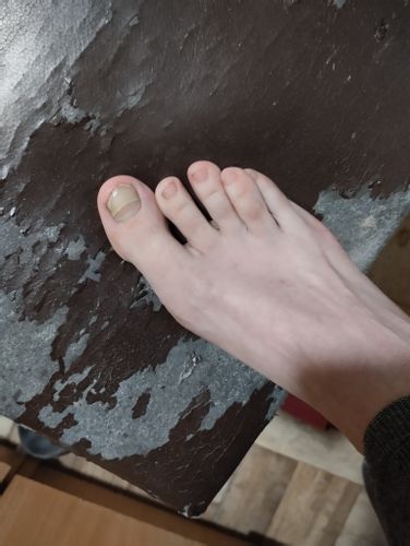 koľko by ma vyšiel zákrok keď potrebujem upraviť alebo skrátiť palec