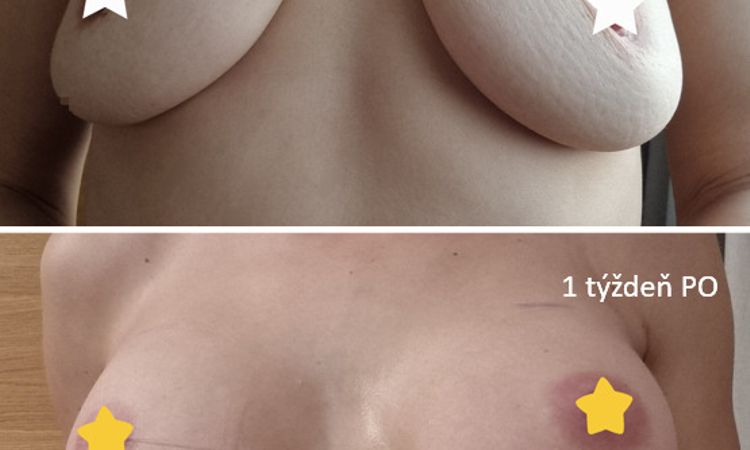 Spackana augmentacia? Kockate prsia - 61228