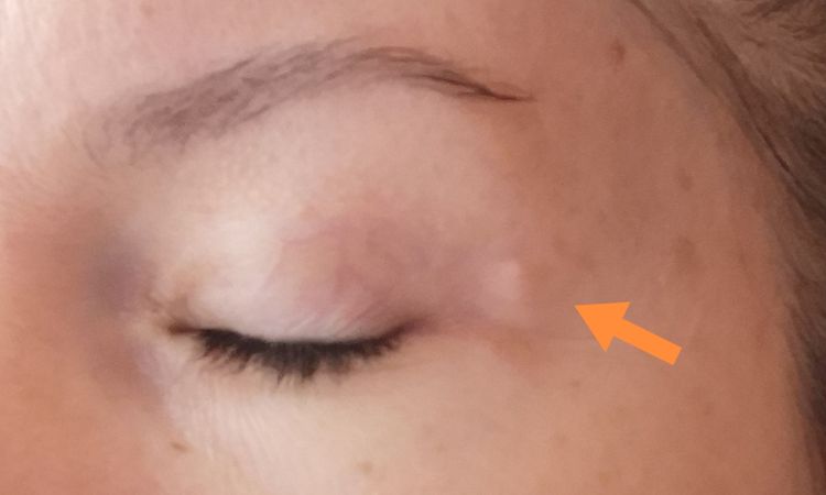 Výrastky po blepharoplastike - 64064