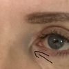 Epikanty po operácii očných viečok