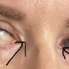 Epikanty po operácii očných viečok