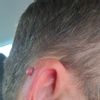 Odstránenie znamienka na uchu ktoré rastue