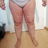 Lipedém. Ktory lekari sa zaoberaju liposunkoiu na lipedem?