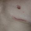 Gynecomastia reoperacia