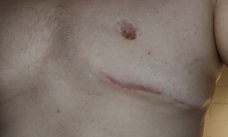 Gynecomastia reoperacia - 67631