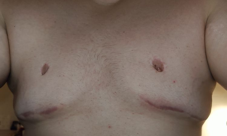 Gynecomastia reoperacia - 67632