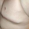 Gynecomastia reoperacia