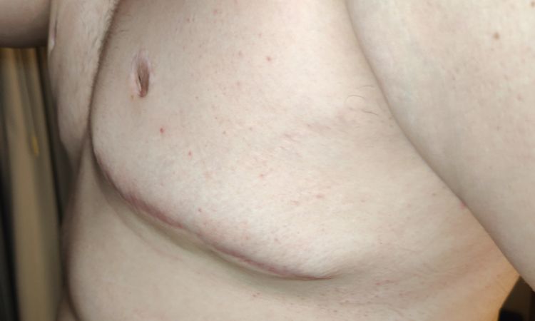 Gynecomastia reoperacia - 67633