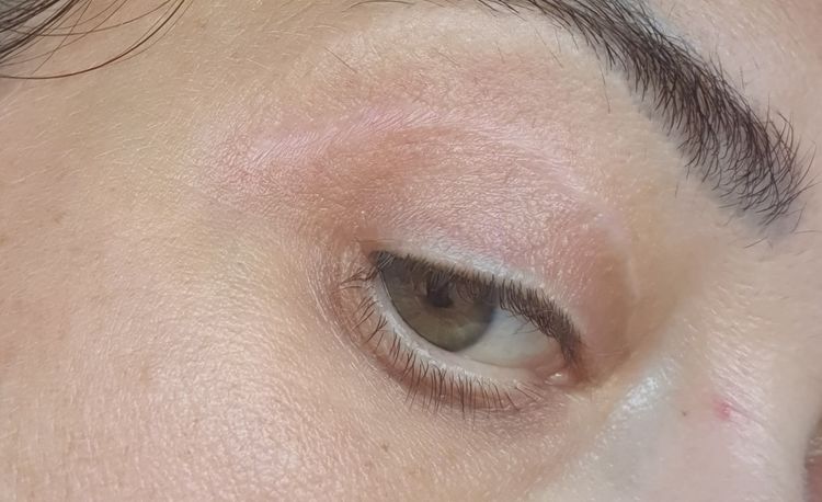 Odstranenie jazvy po blepharoplastike