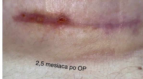 Augumentacia prsnikov - 70241