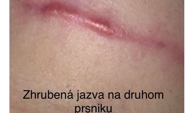 Augumentacia prsnikov - 70244