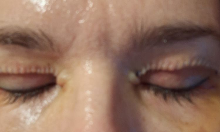 Stehy pri blepharoplastike - 74866