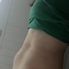 Liposukcia alebo miniabdominoplastika?