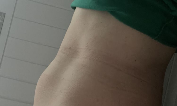 Liposukcia alebo miniabdominoplastika? - 75881