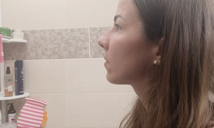 Rhinoplastika mäkkých častí v lokálnej anestézii - 77583