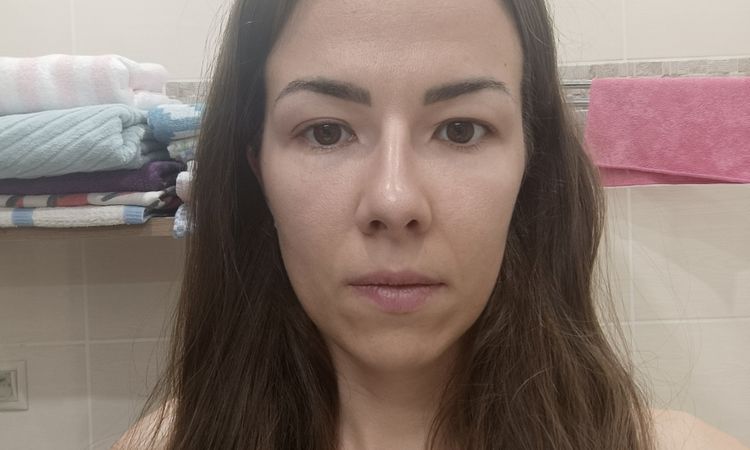 Rhinoplastika mäkkých častí v lokálnej anestézii - 77586