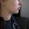 Injekcna lipolyza tvare