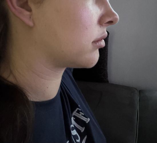 Injekcna lipolyza tvare