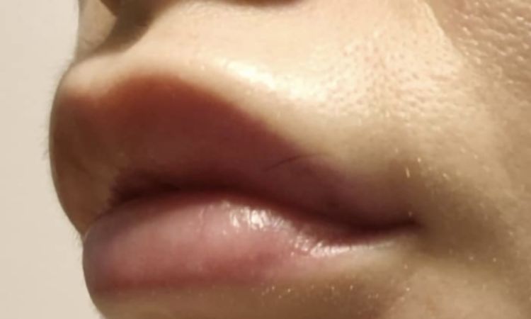 Reakce na vyplň rtu KH - 83142