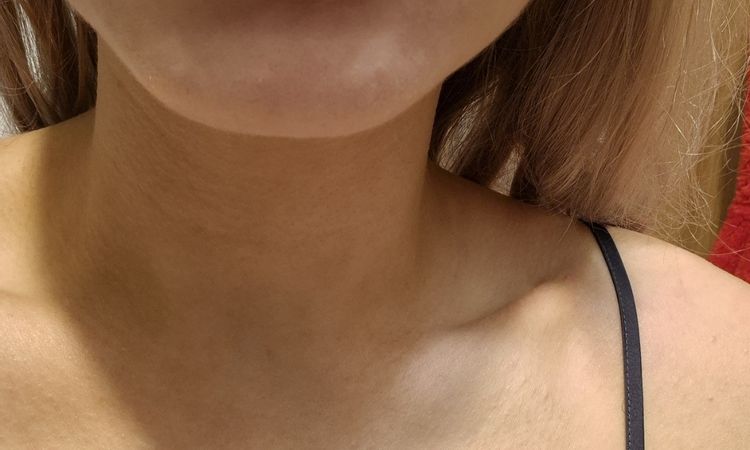 Reakce na vyplň rtu KH - 83143