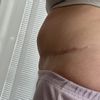 Po abdominoplastike …