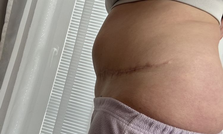 Po abdominoplastike … - 83479