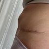 Po abdominoplastike …