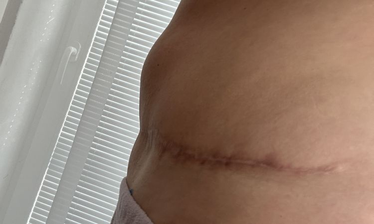 Po abdominoplastike … - 83480