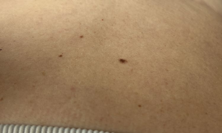 Po abdominoplastike … - 83481