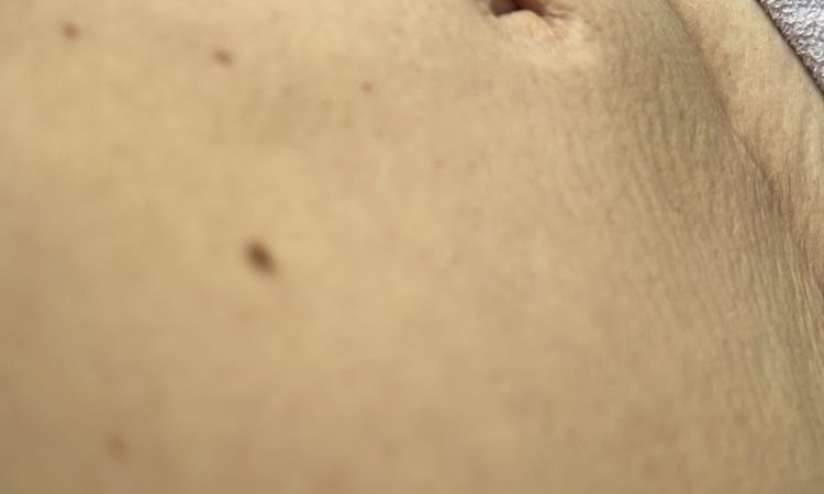Po abdominoplastike … - 83482