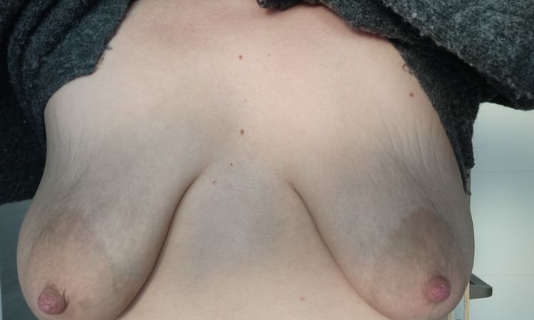 tuberozne prsia - korekcia - 83633