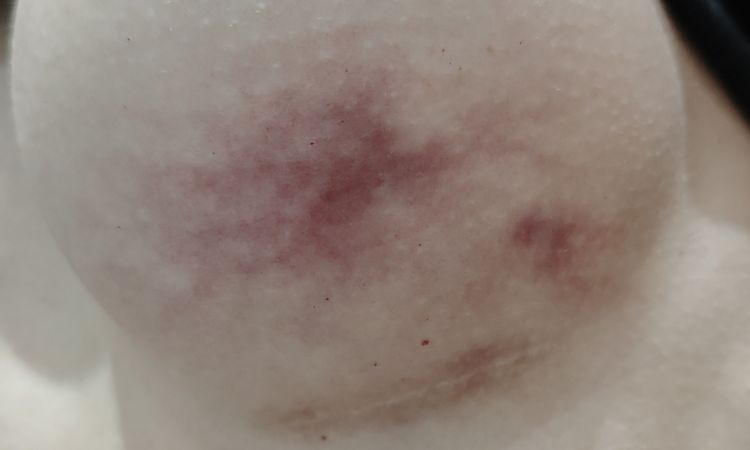 Modrina alebo podliatina na jednom prsníku - 83994